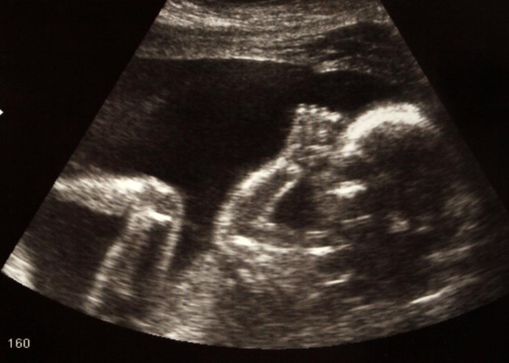 Many cases of placenta previa can be diagnosed via ultrasound.