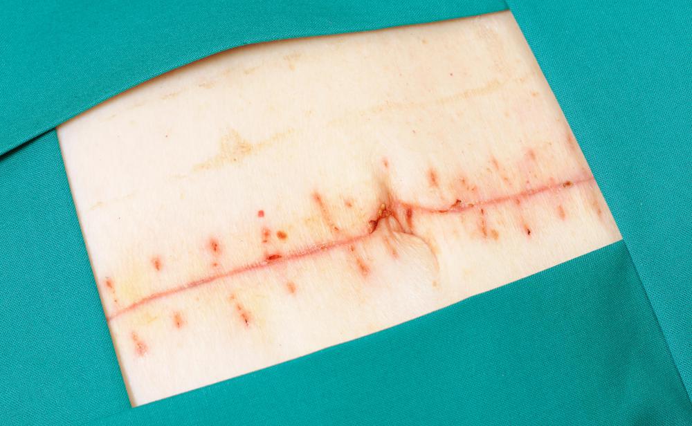 Stitches may be used after surgery to help with healing and prevent excessive scarring.