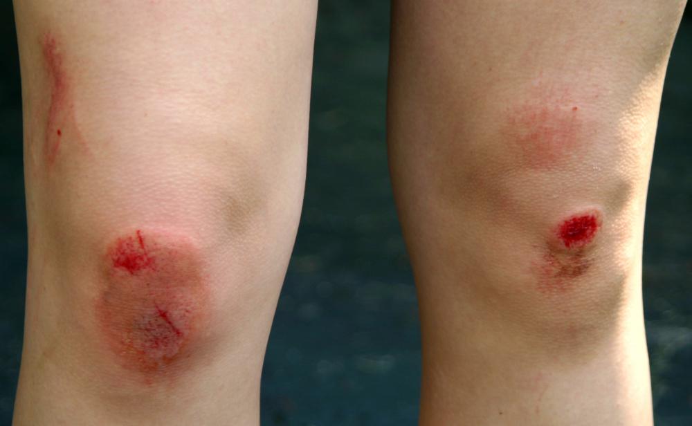 Signs of infection include swelling at the site of the cut or abrasion.