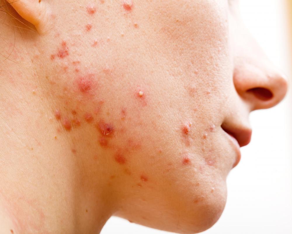 Coal tar soap may be useful in treating acne.
