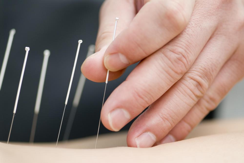 Acupuncture may treat a pinched nerve.