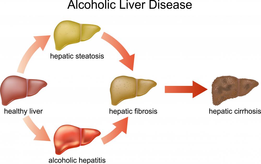 A vein bypass might be performed on someone with advanced liver disease.