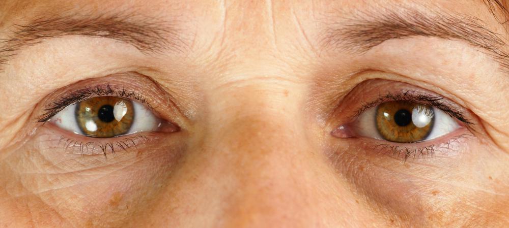 Nearsightedness is the most common eye defect.
