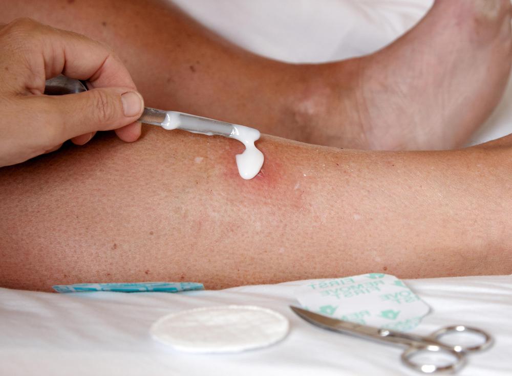 Using an applicator to apply antibiotic ointment helps keep the area free of germs.