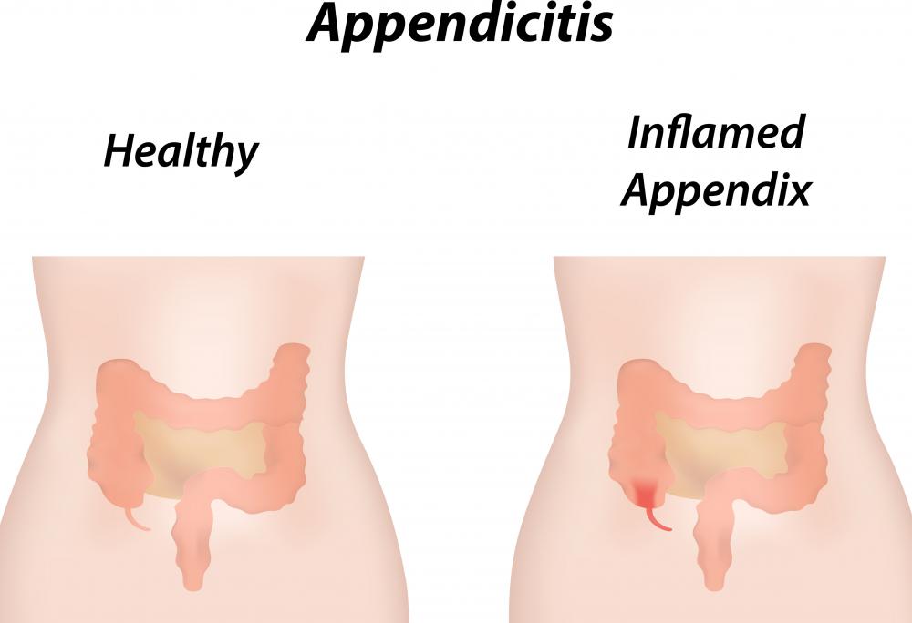 A ruptured appendix may lead to peritonitis.