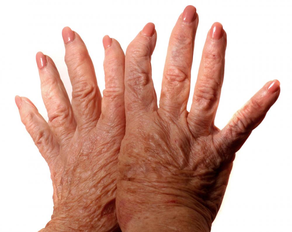 Symptoms of lupus may include joint pain.