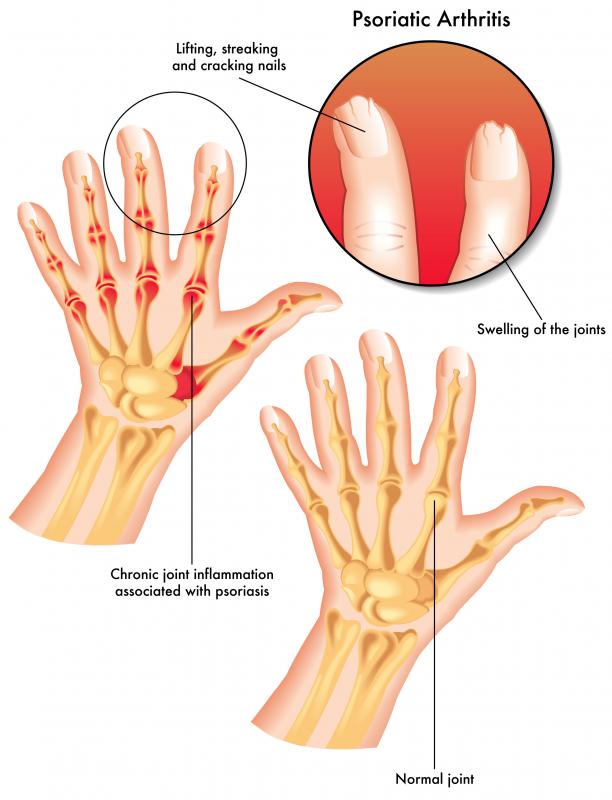 Arthritis mutilans is commonly associated with psoriatic arthritis.
