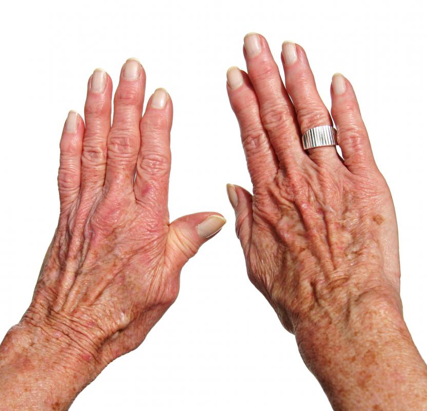 Arthritis is the term used for explaining joint damage and pain.