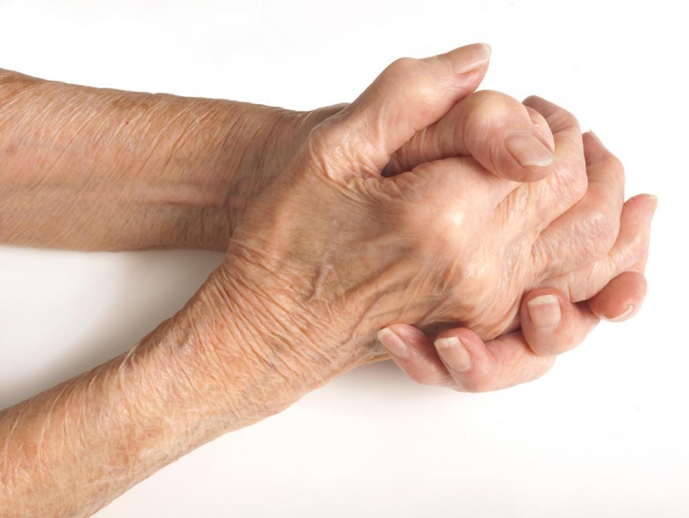 Hands affected by arthritis.