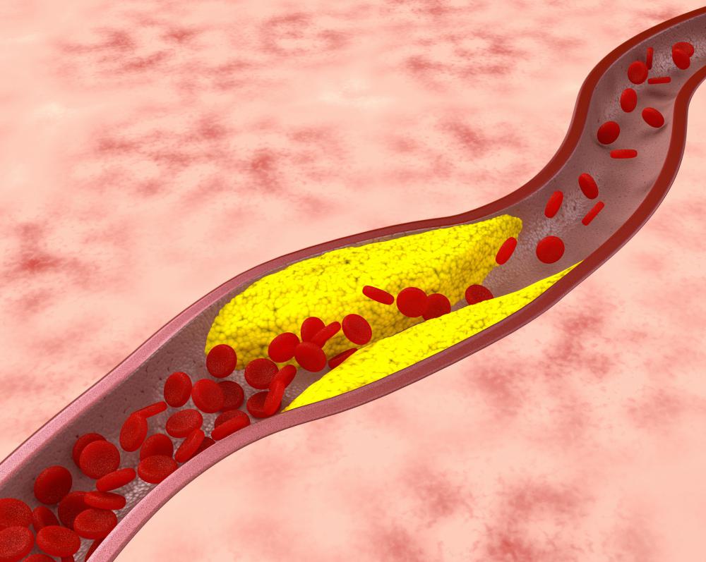 The internal mammary artery is known to be resistant to the development of atherosclerosis, when plaque builds up in the artery.