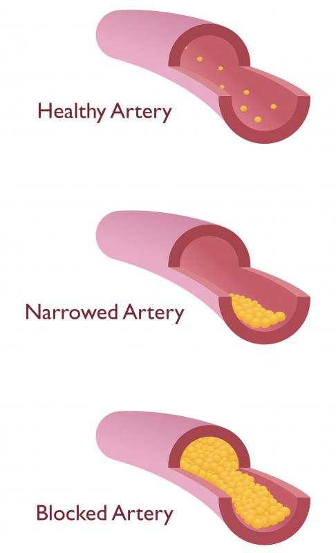 The arteries in the Circle of Willis may be enough to preserve blood flow to the brain even if one artery is constricted or blocked.