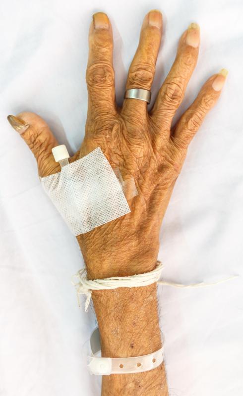 Muscle atrophy in the hands can be a sign of nerve damage.