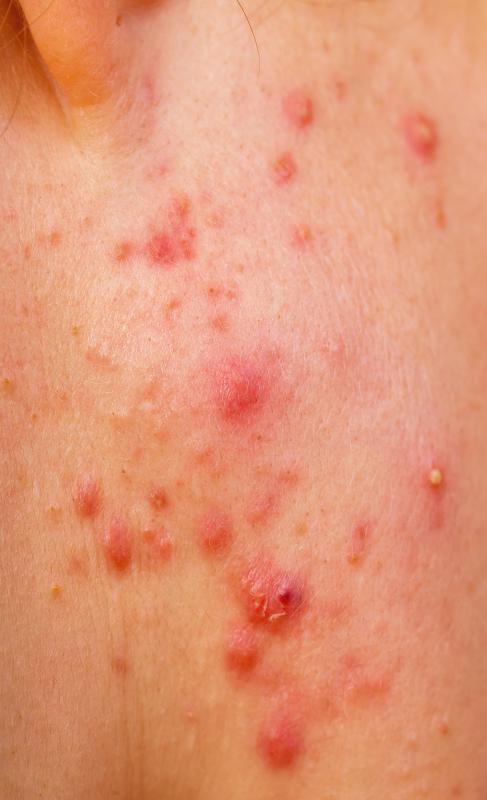Hydrogen peroxide is sometimes used in the treatment of acne.