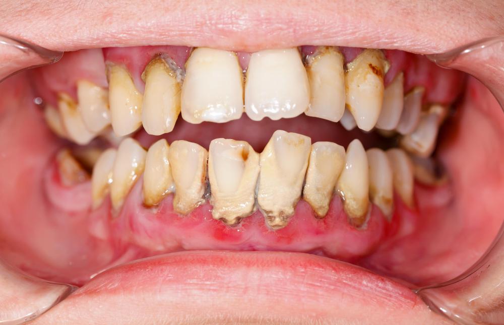 Calcarea fluroica being added to drinking water can help prevent tooth decay in many populations.