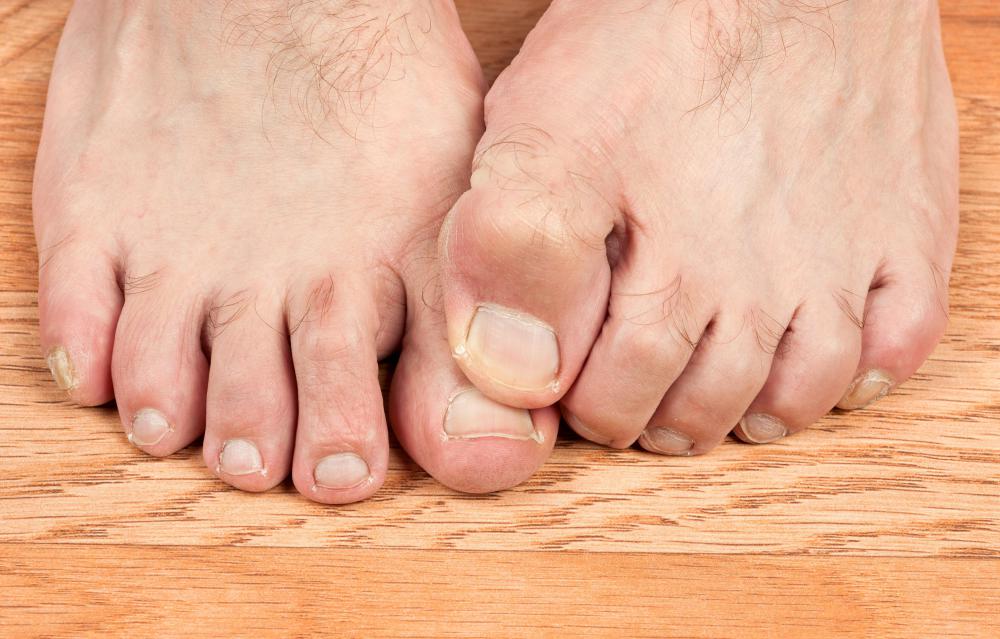 Walking barefoot in public places is a huge risk factor for developing plantar warts.