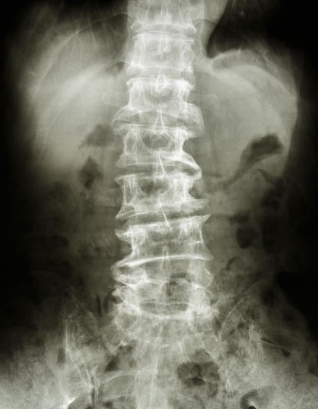 The presence of bone spurts may narrow a person's spinal canal.
