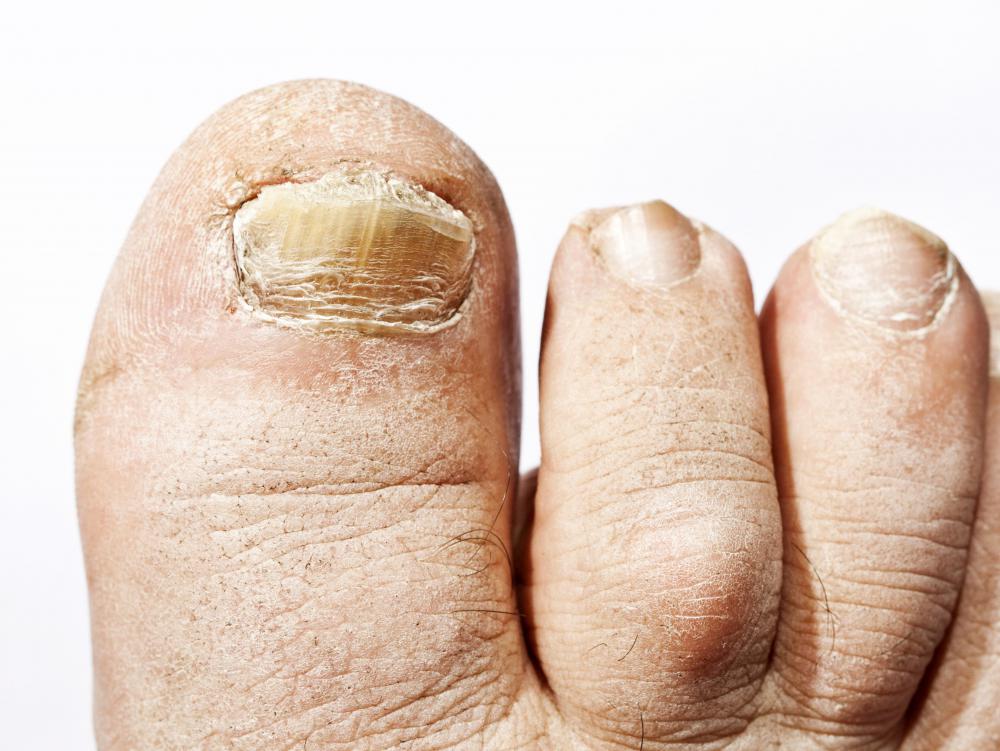 It's possible for an infected toe to become enlarged.