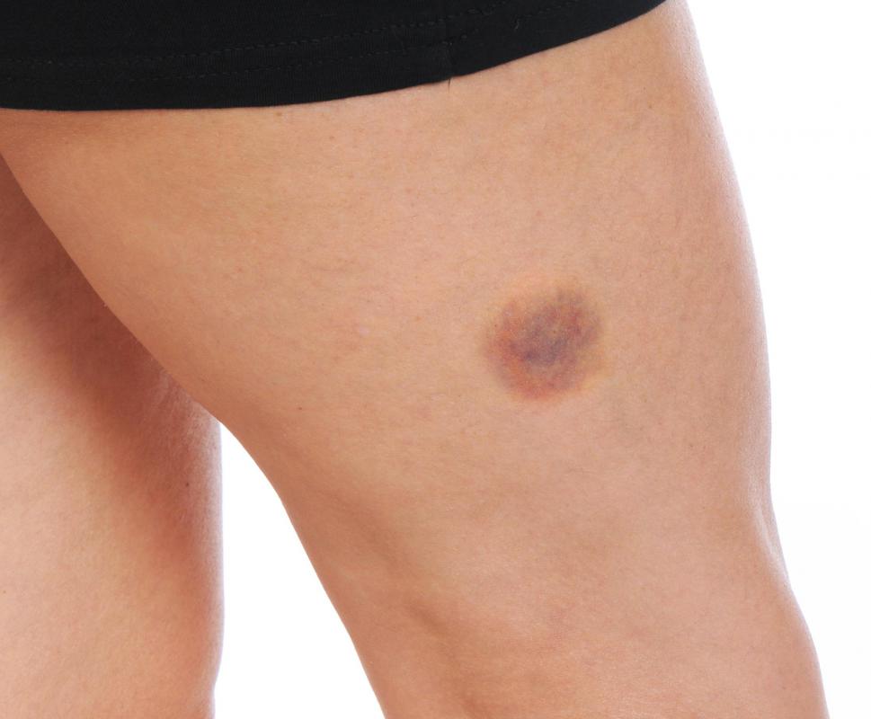 Scurvy causes wounds, cuts, and bruises to take much longer to heal.