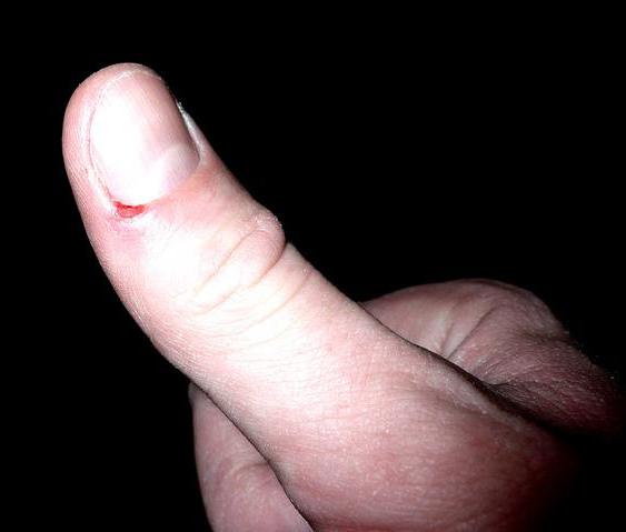 Improper removal of a hangnail may cause an infection to develop.
