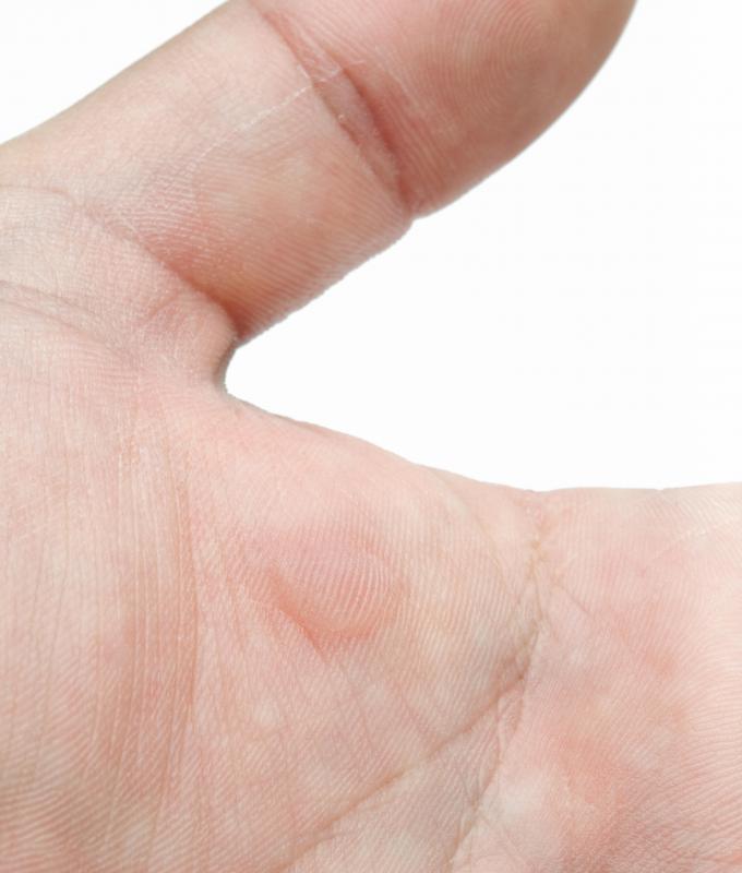 Impetigo skin infections often present themselves through blisters on the hands.