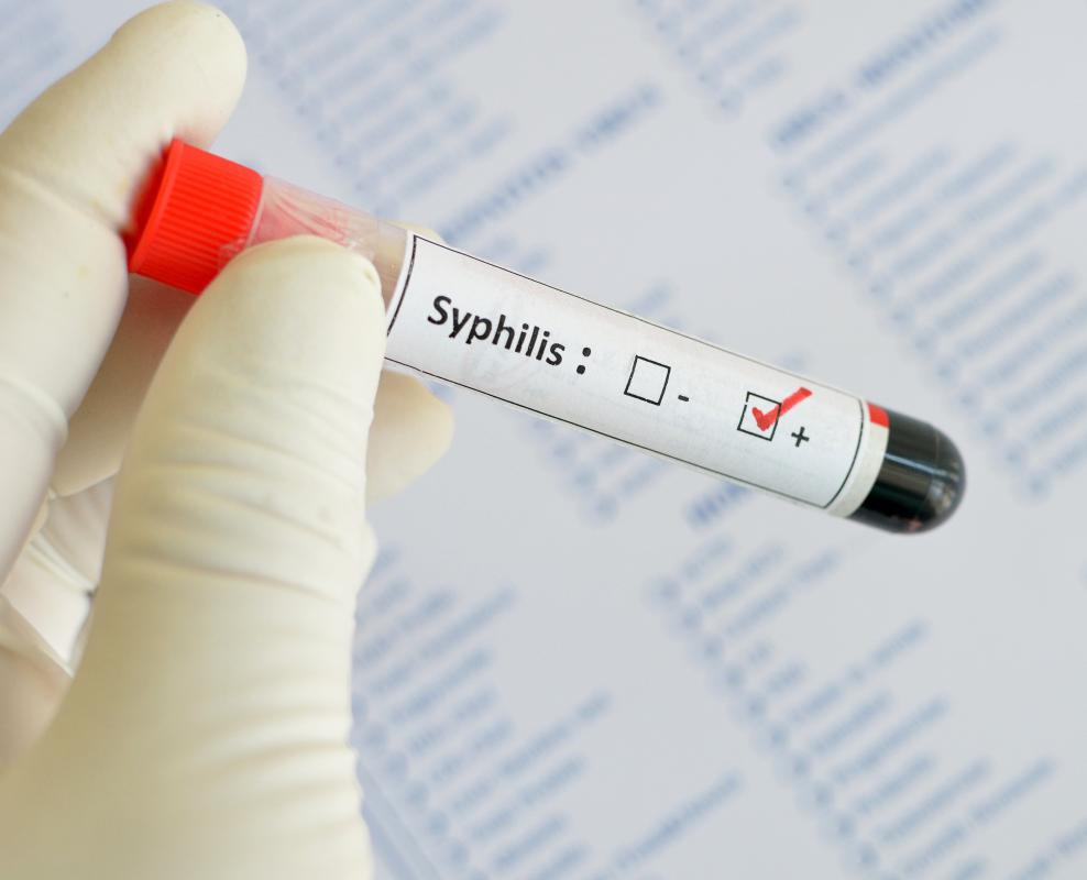 Syphilis, if untreated, can eventually cause heart damage, strokes, seizures and blindness.
