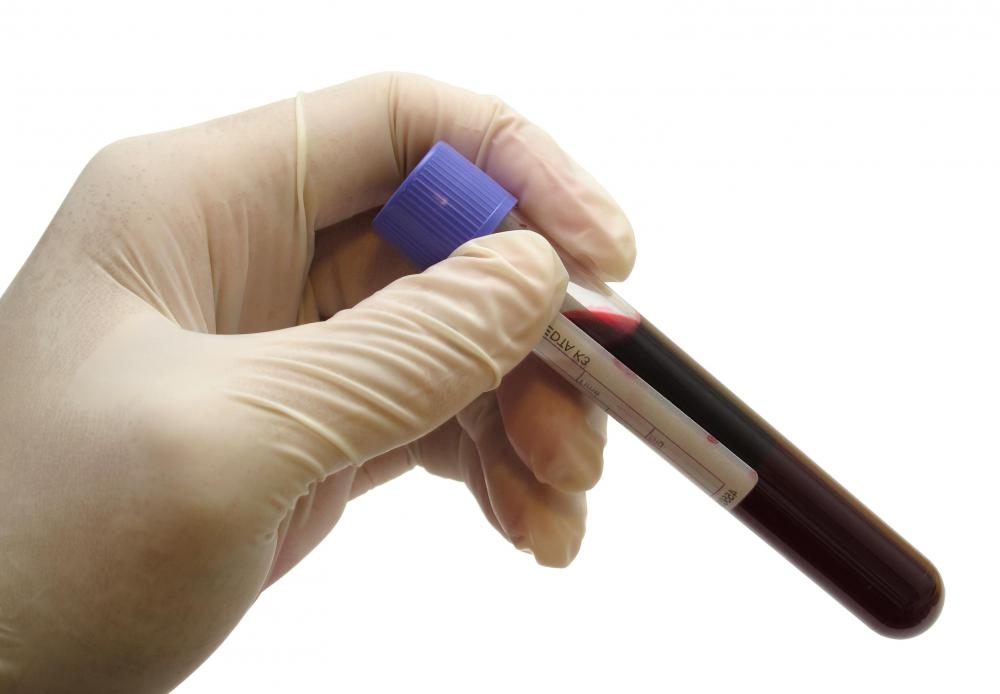 Blood analysis helps physicians monitor a patient's serum cholesterol levels.