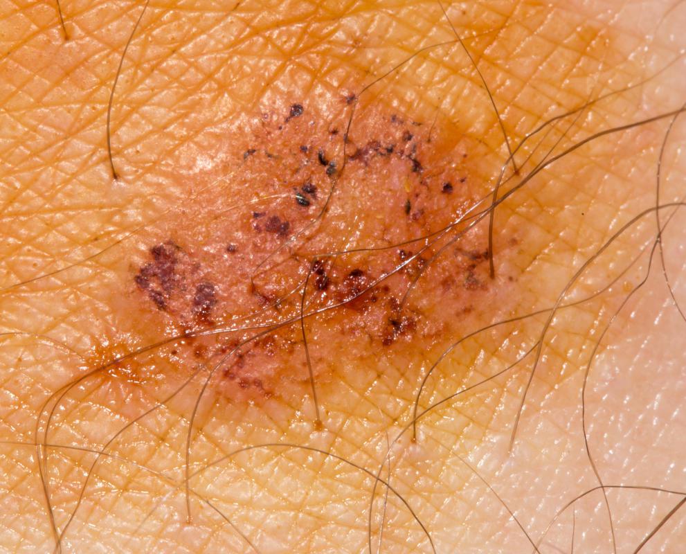 Ringworm of the body is a fungal infection characterized by red patches with scaly edges.