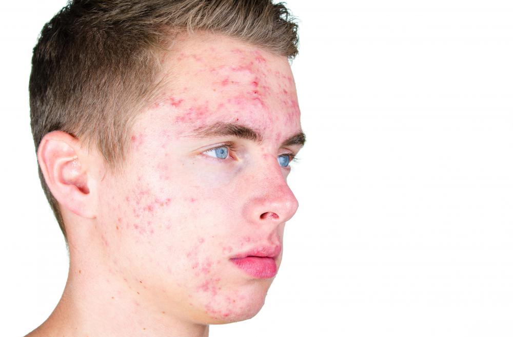 Avoiding stress helps alleviate pimples.