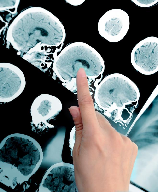 The brain is relatively unaffected by an MRI.