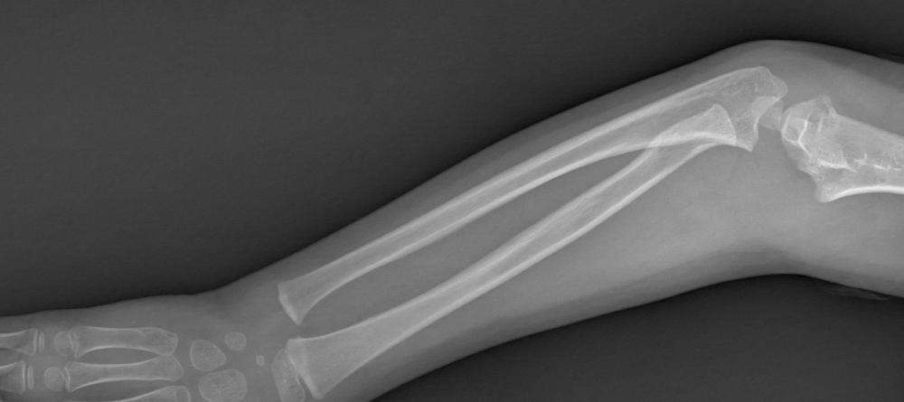 A bone fracture is a more serious cause of pain in the right arm.