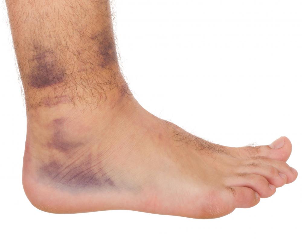 Liniment oil may be used to treat bruises and sprained muscles.
