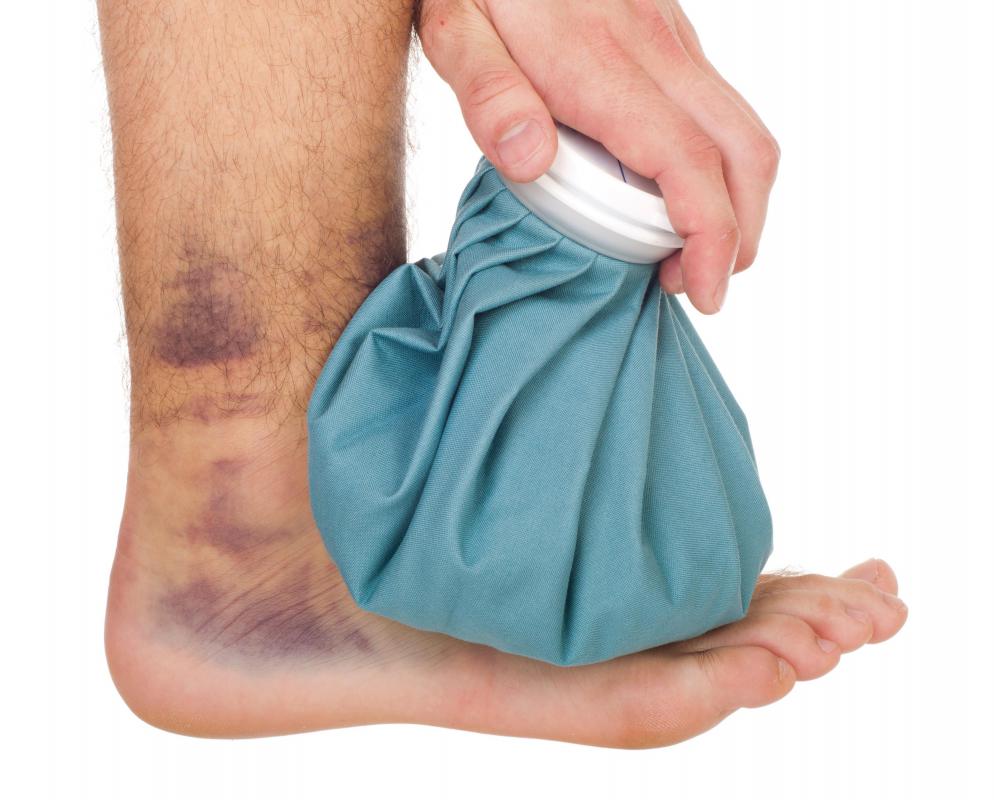 A man with a bone contusion.
