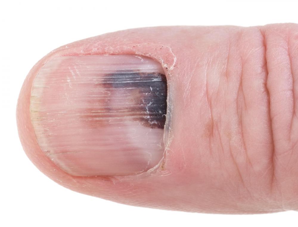 A bruised thumb should be elevated above the heart.