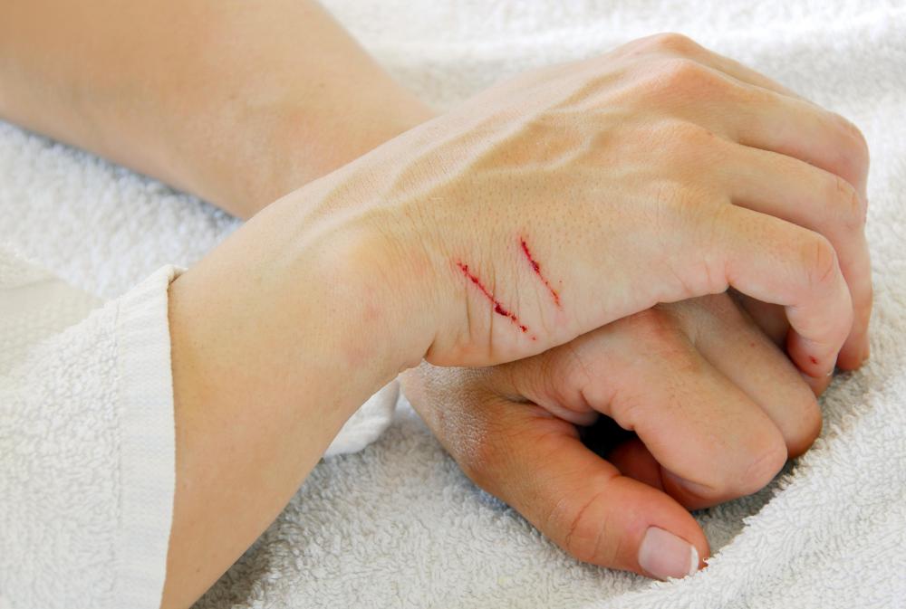 Getting scratched by a cat could lead to blistering if the animal has the bacteria that causes cat scratch disease.