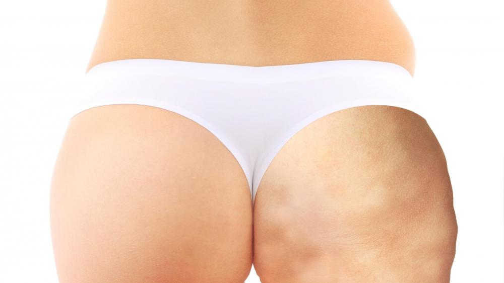 If treatment is not regularly sought, endermologie does not permanently reduce the dimpling effect of cellulite.