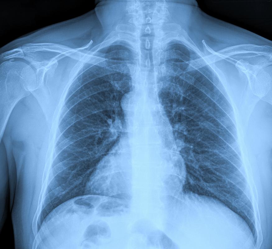 Pneumonia may be diagnosed with a chest X-ray.
