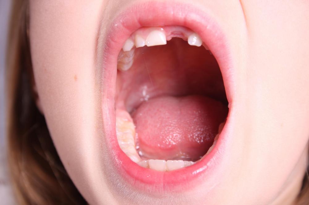 Losing teeth as a child is one of the most common types of tooth mobility.