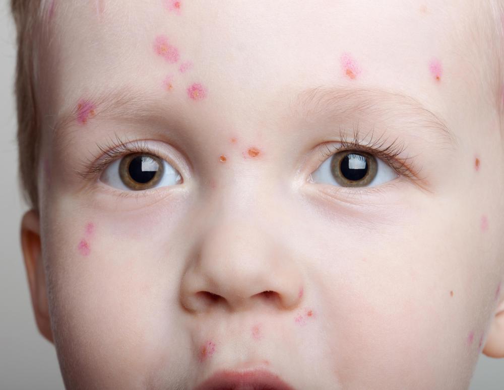 Ig injections were once given as a temporary boost to the immune system after someone was exposed to chicken pox.