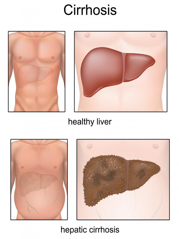 Cirrhosis kills more than 25,000 people per year.