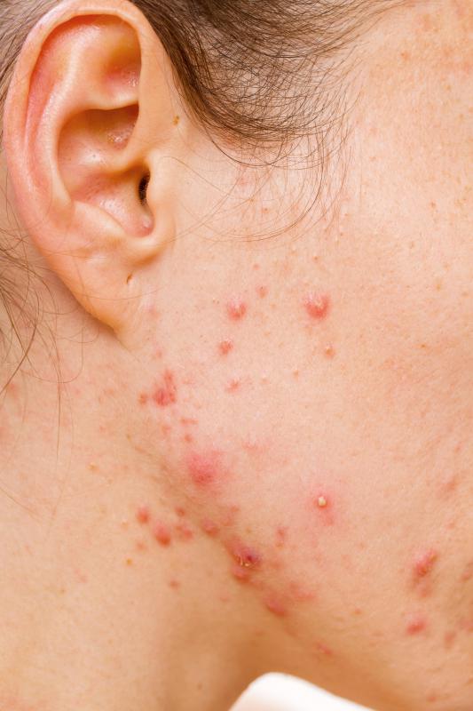 Breakouts can prevent someone from having porcelain skin.