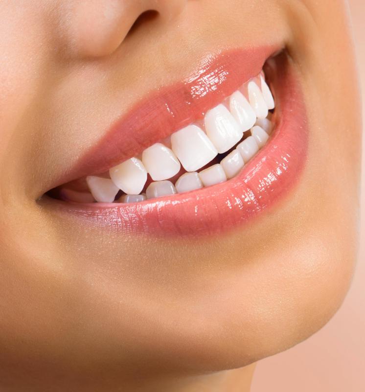UV teeth whitening kits may cause mouth and gum irritation because of the strong bleach used.