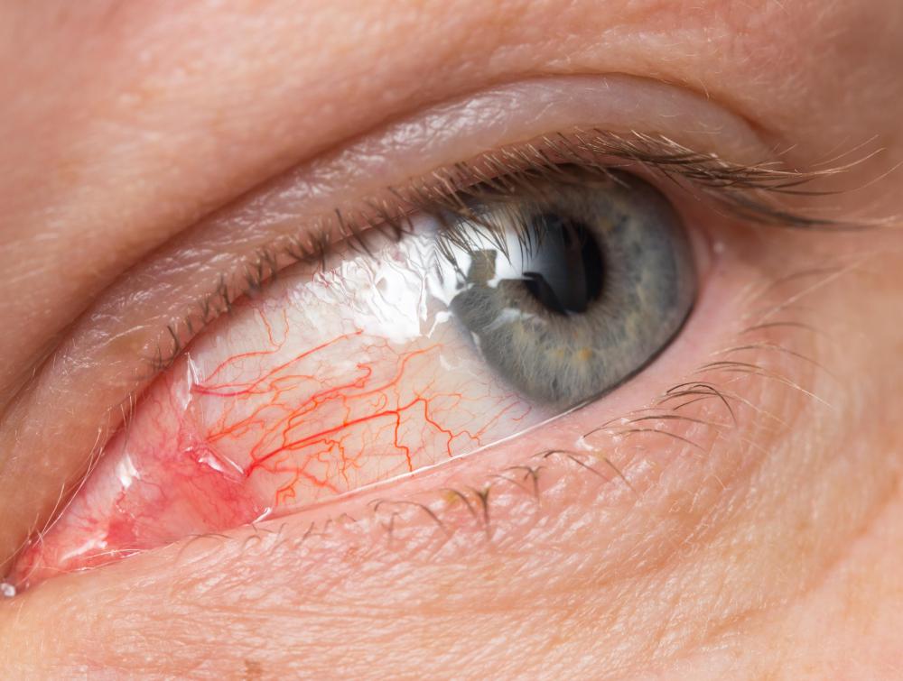 Symptoms of measles may include red eyes or conjunctivitis.