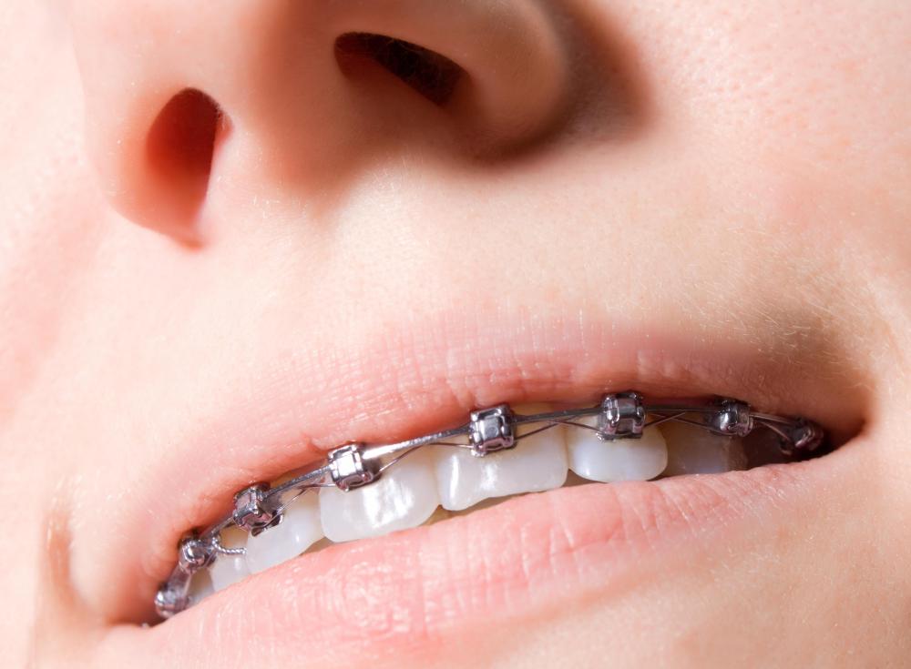 Braces are used to correct problems like overbites.