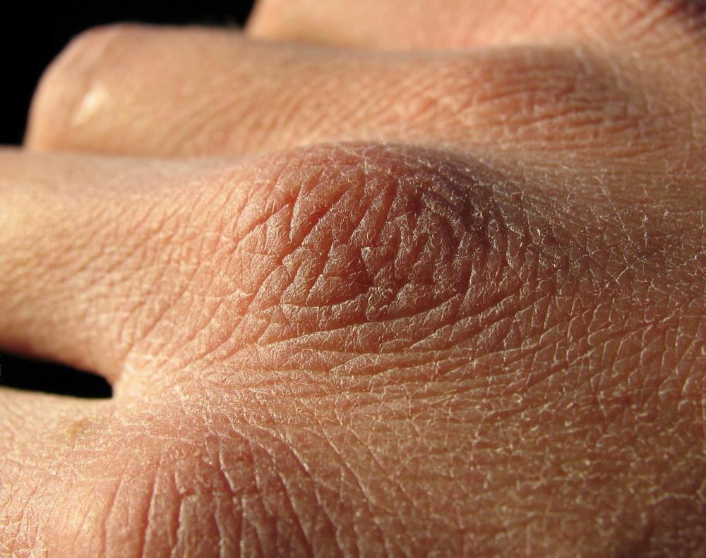 Dry skin is the most common effect of hard water on skin.