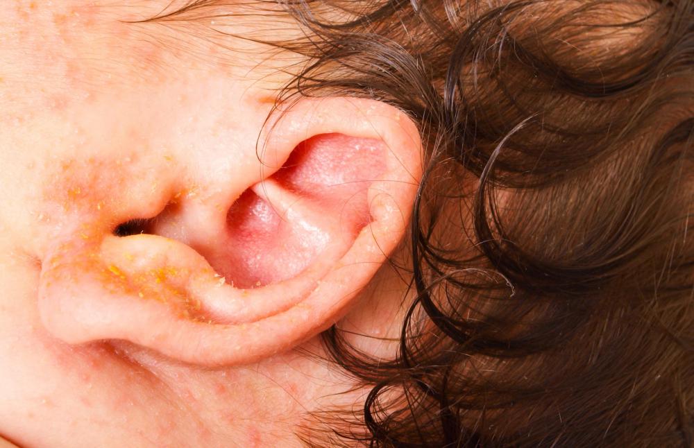 Skin conditions like eczema can irritate the ear.