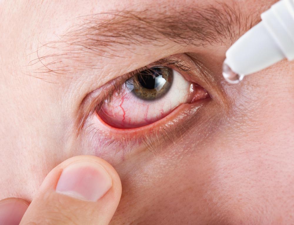 Eye drops may help relieve itchy eyelashes.