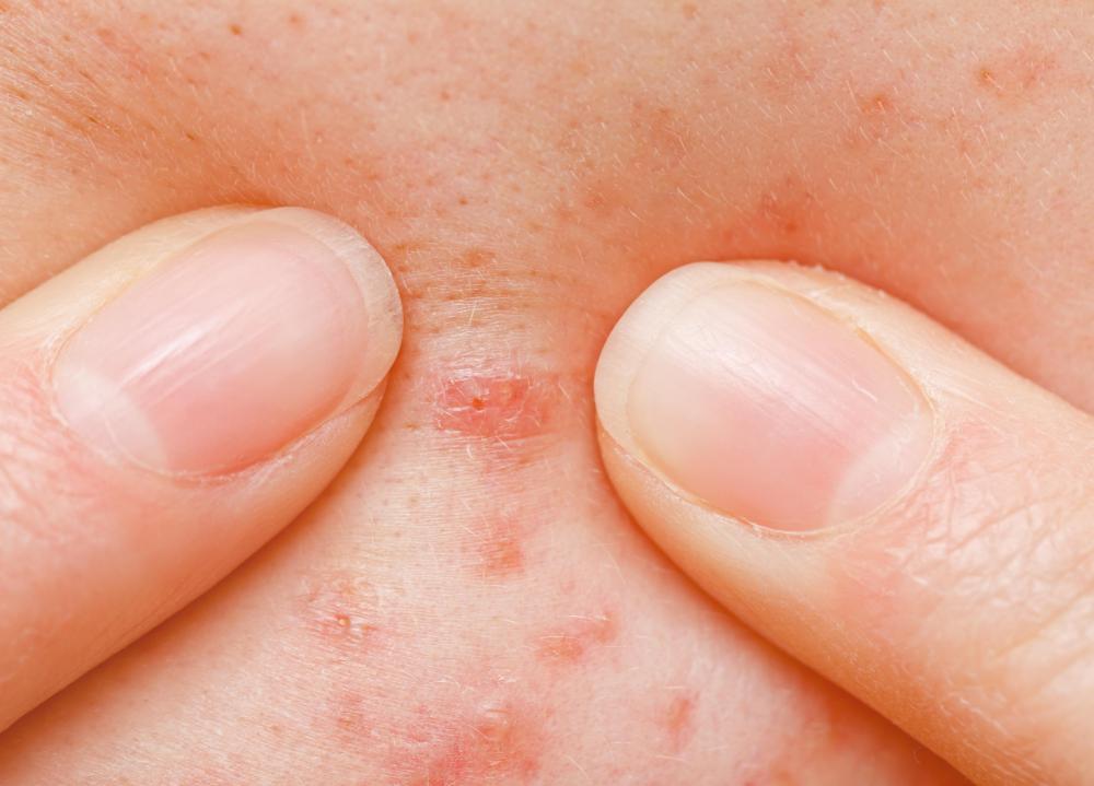 Kojic acid may be used to treat acne.