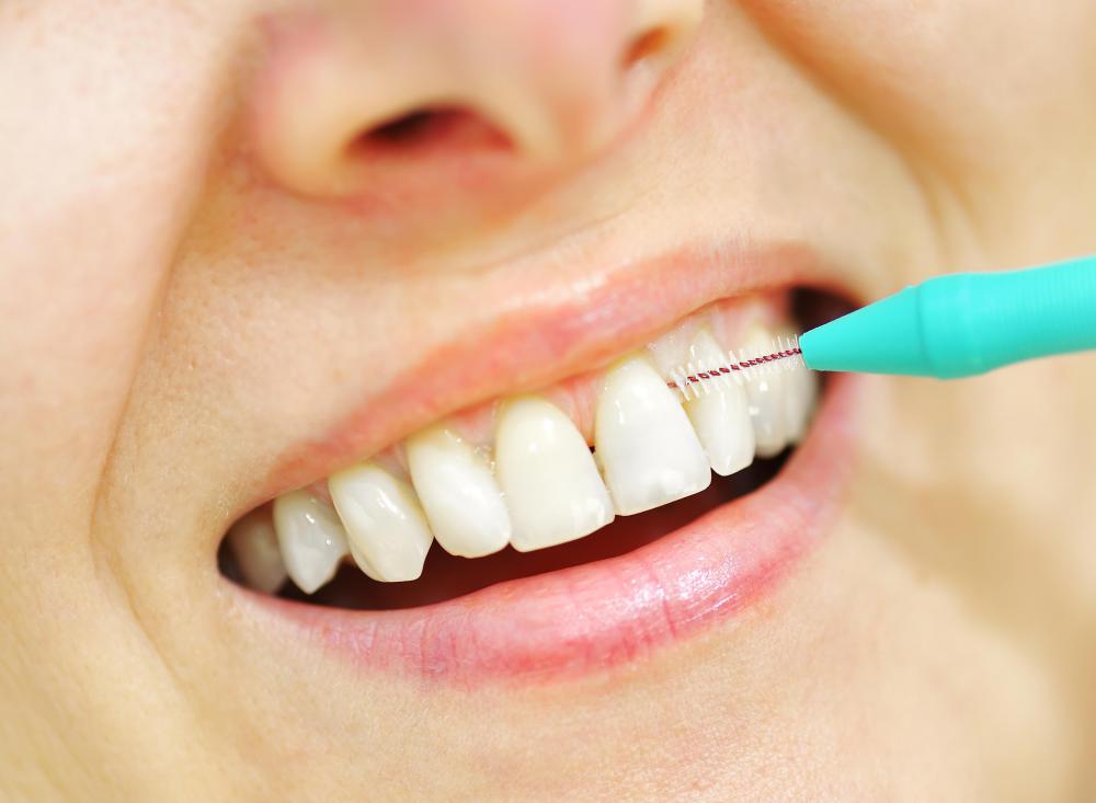 Regular teeth cleaning sessions can help reduce the amount of disease-causing bacteria that enters the teeth through the gums.