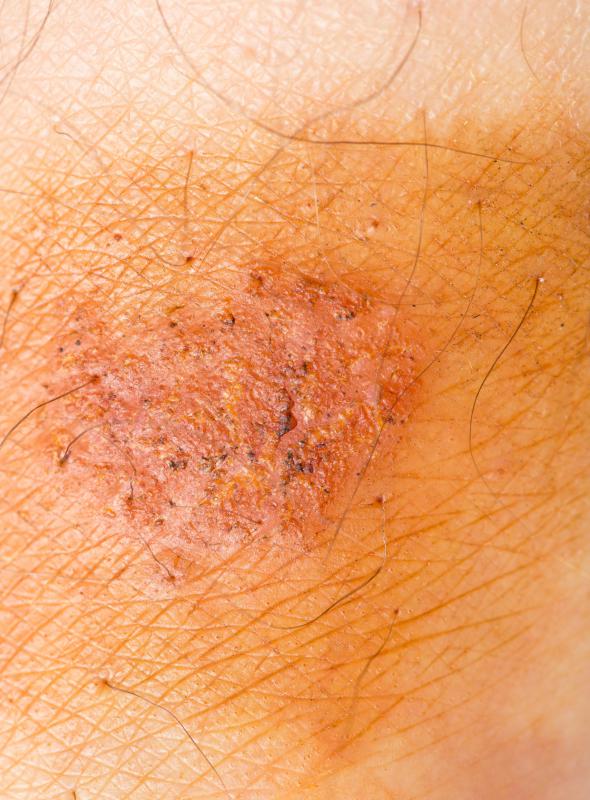 A rash is a common symptom of Lyme disease.