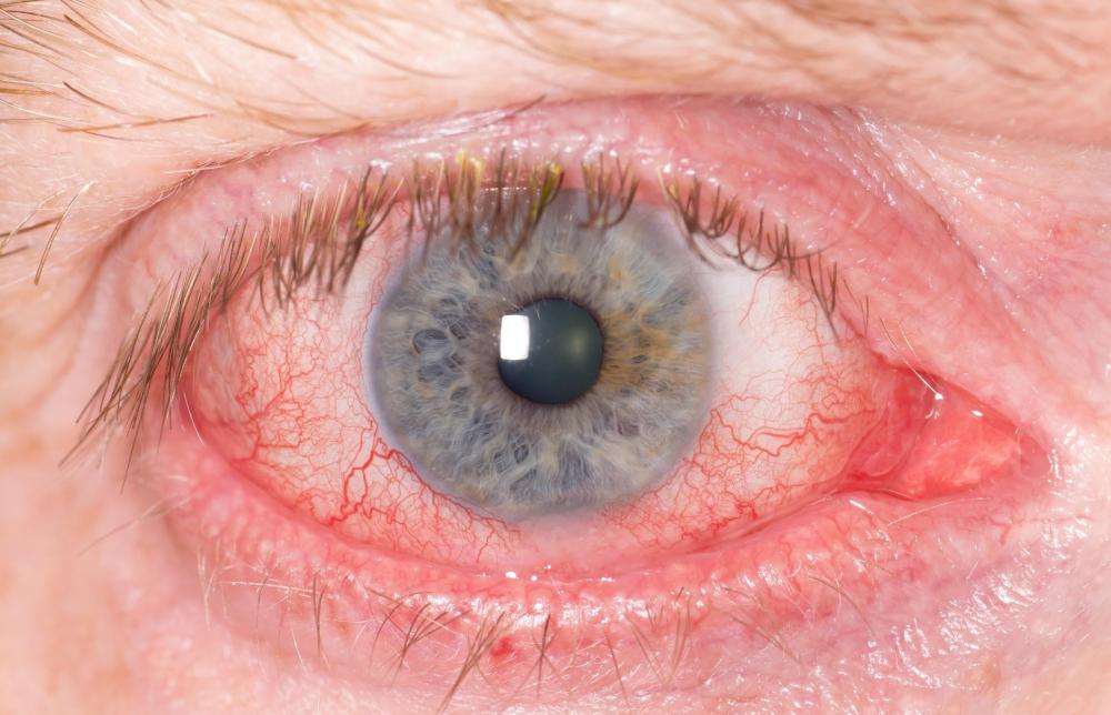 When in human form, an aswang will have bloodshot eyes.